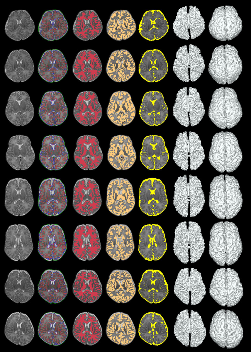 neonatal image segmentation neonate brain segmentation longitudinal image