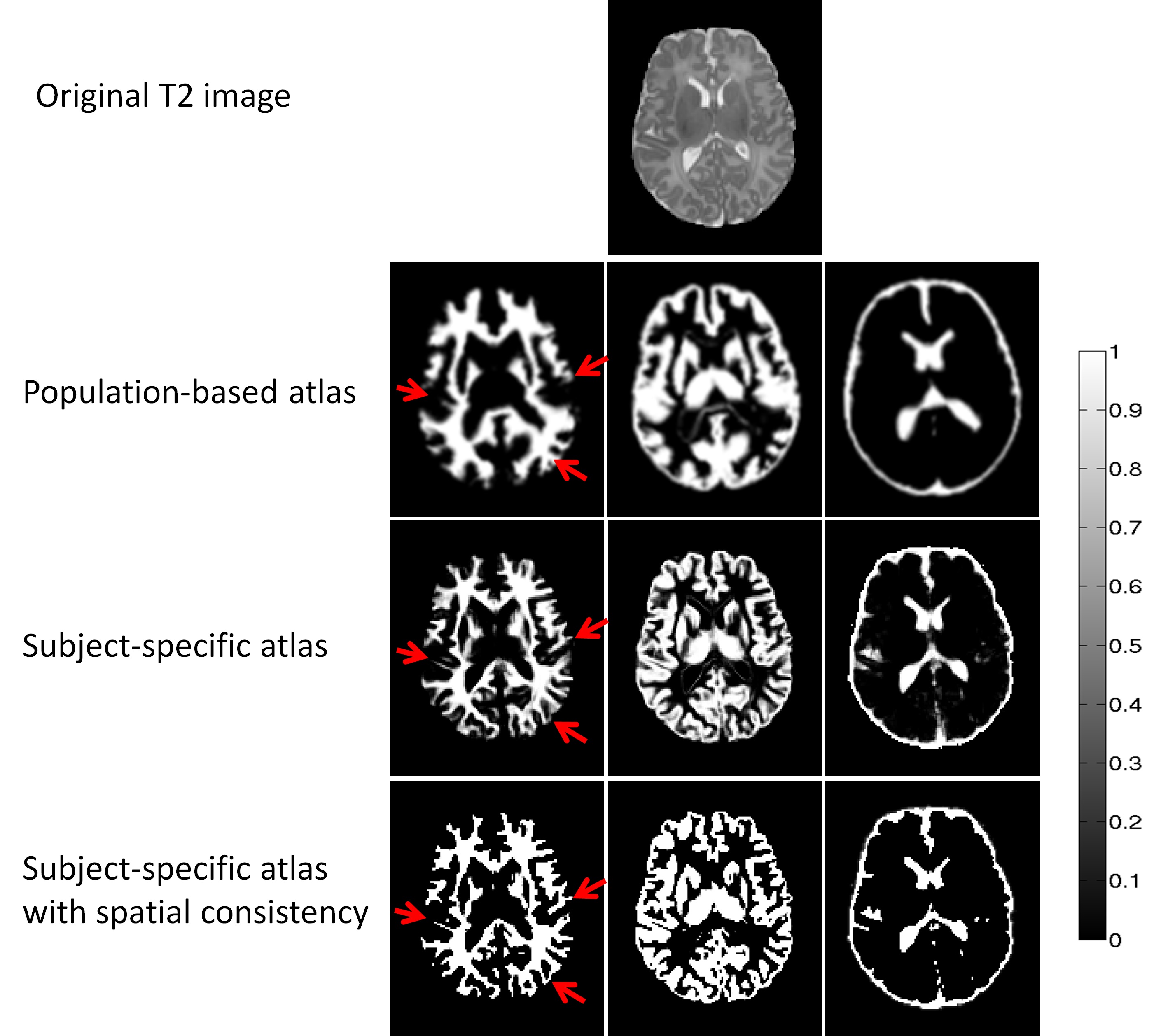 Neonatal Brain MR Image Segmentation using Patch-Driven Level Sets